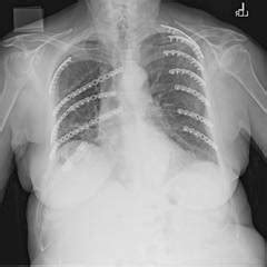 Partial flail chest stabilization may suffice | CHEST Physician