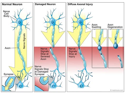 Damaged Neurons and Diffuse Axonal Injury – Medmovie.com