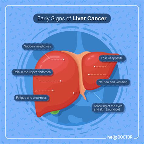 What Happens in Liver Cancer: All You Need To Know - Hello Doctor