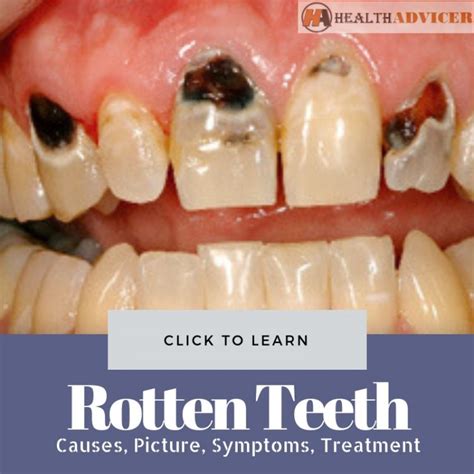 Rotten Teeth: Causes, Picture, Symptoms And Treatment