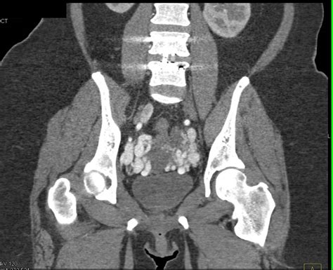 Pelvic Congestion Syndrome - OB/GYN Case Studies - CTisus CT Scanning