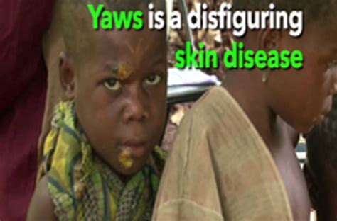 Yaws Disease (Frambesia)