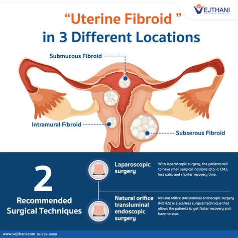 The Difference of Uterine Fibroid in 3 Different Locations