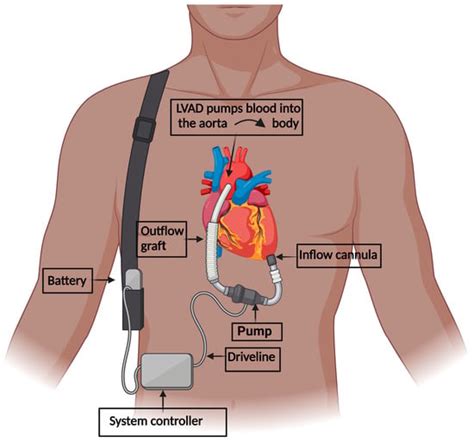 IJMS | Free Full-Text | Depression among Patients with an Implanted Left Ventricular Assist ...