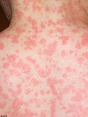 Common Rashes - Eczema Free Skin