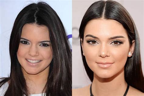 Kendall Jenner, Lip Injections & Plastic Surgery?