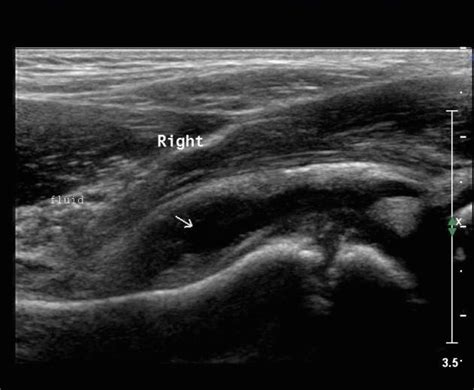 Transient Synovitis