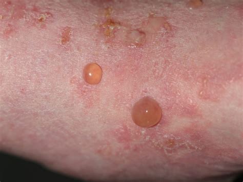 Bullous Pemphigoid - Causes, Symptoms, Treatment