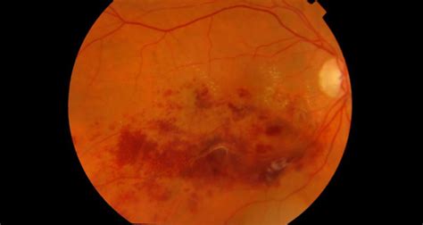 Central Retinal Vein Occlusion | Rila Institute of Health Sciences