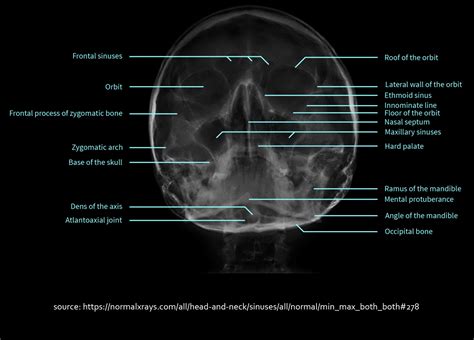 Labeled Normal Sinuses X-Ray