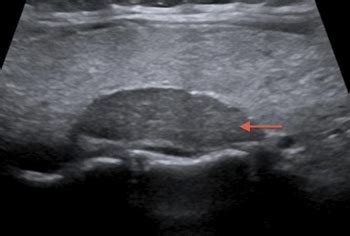 Thyroid Parathyroid Ultrasound