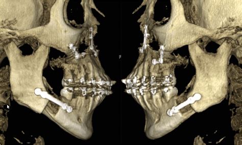 Three-dimensional presentation of a bilateral sagittal split osteotomy... | Download Scientific ...