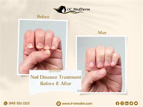 Nail discoloration treatment irvine orange county – Artofit