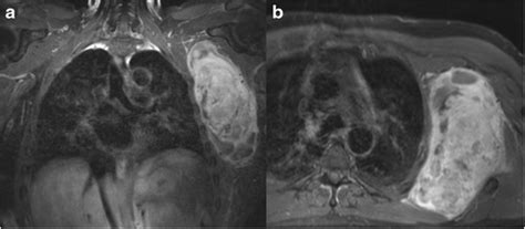 Forequarter amputation: a safe rescue procedure in a curative and palliative setting in high ...