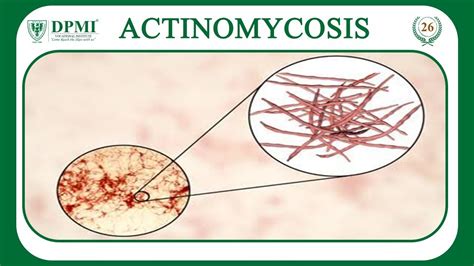 Actinomycosis: What Is Actinomycosis? Actinomycosis: Diagnosis, Clinical Features and Treatment ...