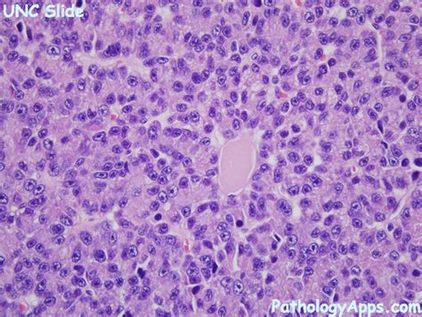 acinar cell carcinoma pancreas histology