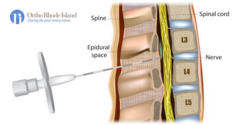 Procedure for Lumbar Epidural Steroid Injection: Steps and Precautions ...