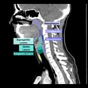 Nasopharynx Anatomy Axial