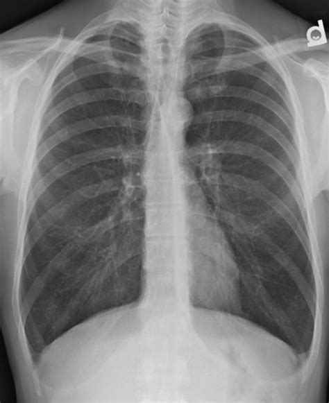 Emphysema Chest X Ray