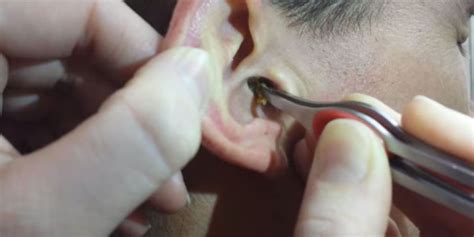 Watch this gross but satisfying video of a man having a HUGE chunk of earwax removed