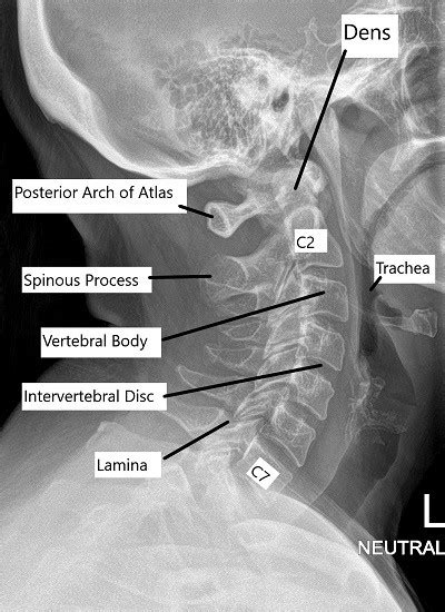 Lumbar Vertebrae Anatomy Xray