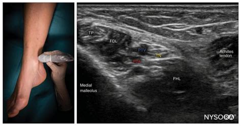 The Underappreciated Potential of Ankle Blocks | Anesthesia Experts