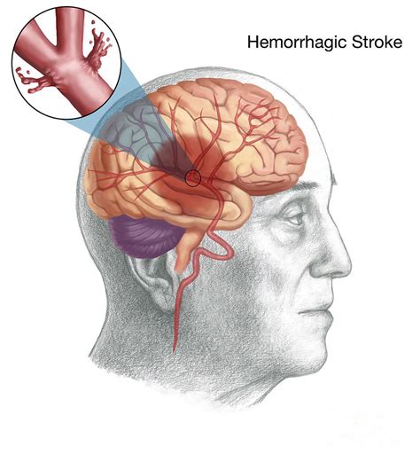 Hemorrhagic Stroke Photograph by Spencer Sutton