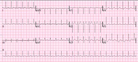 Dr. Smith's ECG Blog: An apparent SVT that does not persistently correct with adenosine