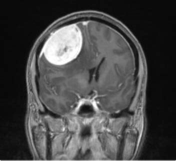 Meningioma | Information, Treatment & Surgery Melbourne