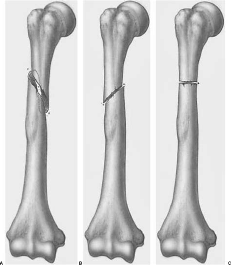 Humeral Shaft Fractures | Radiology Key