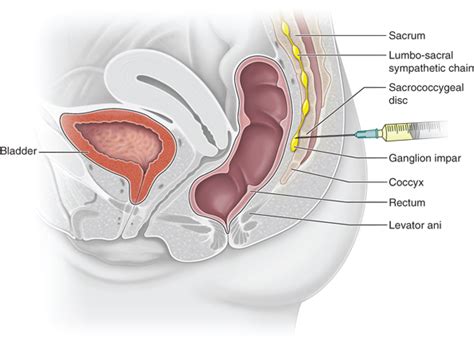 Pin on Coccydynia