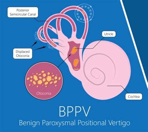 graphic of benign paroxysmal positional vertigo