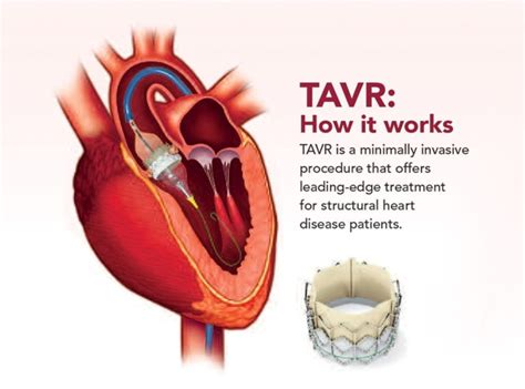 Understanding heart surgery. - St. Clair Health