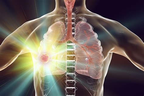 Datopotamab Deruxtecan Improves PFS Vs Docetaxel in Advanced NSCLC