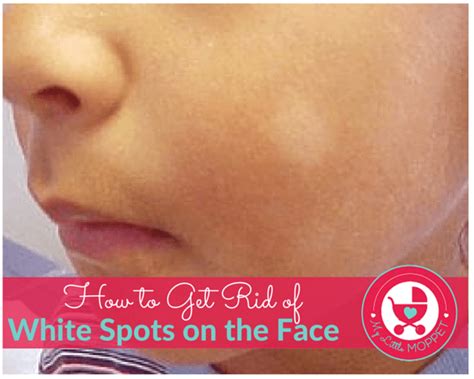 5 ways to get rid of white spots on the face of your child