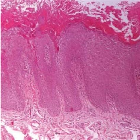 Rough, folded surface of the oral mucosa and thick white plaques. | Download Scientific Diagram