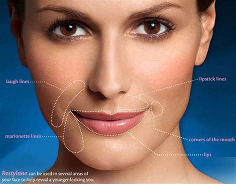 Restylane Defyne Treatments in Chicago | Restylane Defyne Dermal Fillers