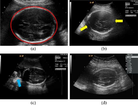 Automatic Fetal Head Circumference Measurement in Ultrasound Using ...