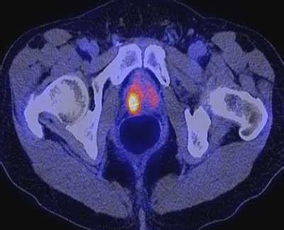 The value of MRI before biopsy - Dr Phillip Stricker