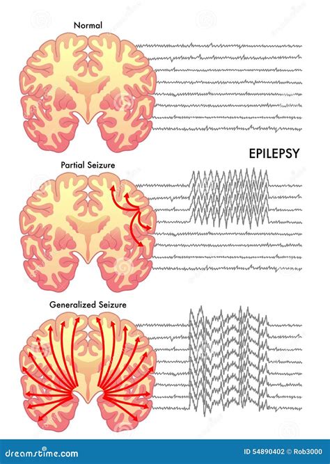 Epilepsie stock foto. Afbeelding bestaande uit zenuwachtig - 54890402