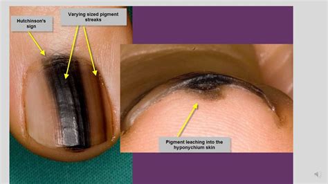 How to identify Skin Cancer on Fingers - Signs & Types