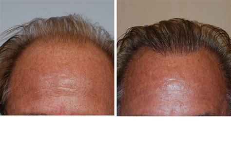 Hair Restoration, Hair Transplant Surgery for Men in New York City ...