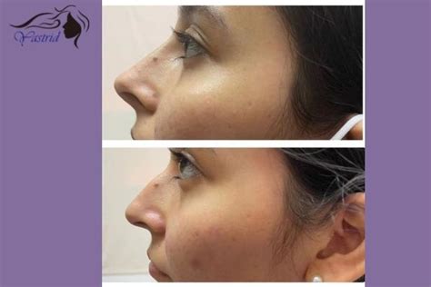 How Much Does a Nose Thread Lift Cost? - Yastrid Medical Aesthetic Supplier