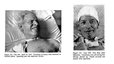 Lobotomy used as a palliative procedure, 'Psychosurgery' by Freeman and ...