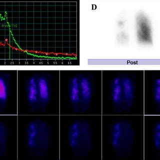 Ventilation and perfusion scan (posterior views). (A) Single-breath ...