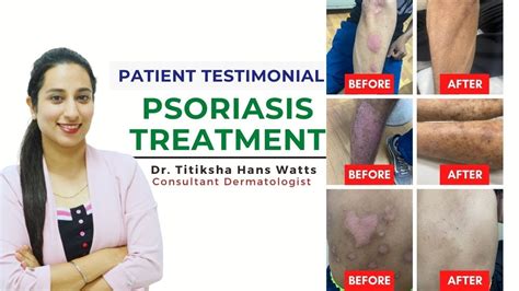 Psoriasis treatment before and after | Psoriasis patient story | सोरायसिस' रोग | Healing ...