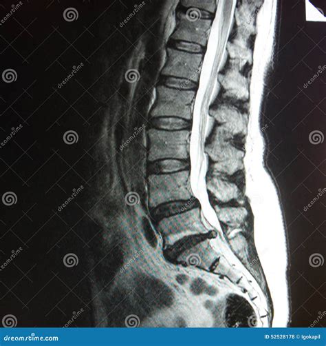 Mri Of Lumbar Spine Stenosis Stock Photography | CartoonDealer.com #52528178