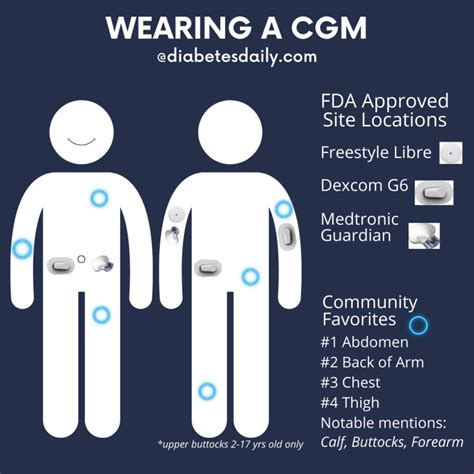 Where Should You Wear Your CGM Sensor? – Diabetes Daily