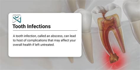 Tooth Infection Treatment | Shalman Dentistry in Lower Manhattan, NY