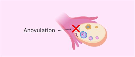 What is anovulation? - Causes, symptoms and treatment